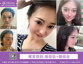 杭州伊琳医疗美容做的双眼皮真实评价 诚信认可毛琪医生的技术