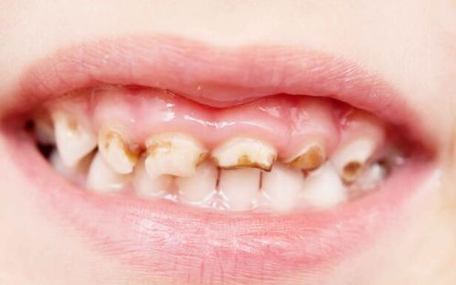 家长要留心观察,孩子牙齿有4种现象,要及早治疗,别忽视