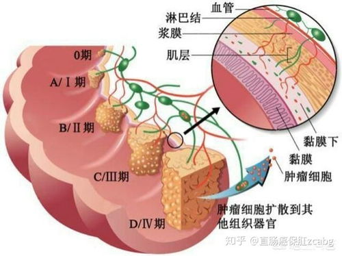 直肠癌保肛中心 直肠癌二期治愈率高不高 能活多久 