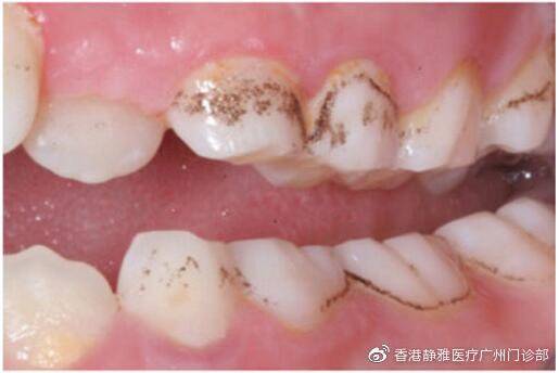 牙菌斑是怎么产生的