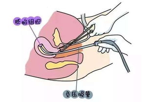 学点医 流产后不久又怀上了 对女性危害大