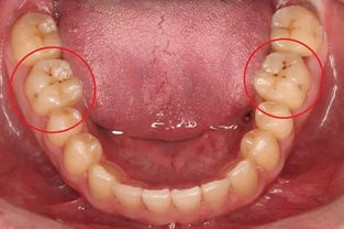 龋齿是怎么产生的 为什么发病率很高