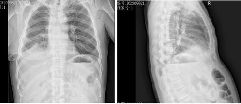 胸部正位主要是检查什么(胸部正位啥意思)