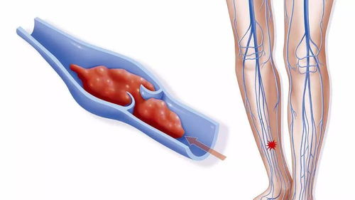 静脉血栓是什么鬼 膝盖蹭破点皮,怎么还危及生命