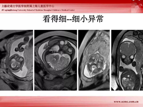 胎儿磁共振的检查技术