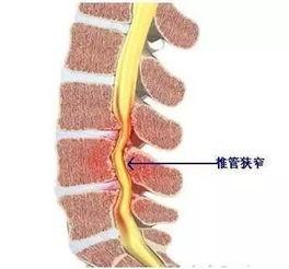 腰腿痛不都是腰间盘突出,还可能是腰椎管狭窄