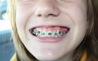 孩子戴上牙套后如何进行日常护理