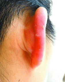 泉州20岁女孩想变美打耳洞 耳朵上长出 小屁股