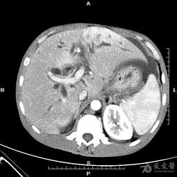 上腹部CT辐射比全腹部CT辐射小吗(上腹部ct辐射比全腹部ct辐射小吗对吗)