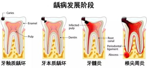 正在牙齿正畸的小伙伴们,疫情期间无法复诊,你们的托槽掉落了吗 现在是掉落的第几天 