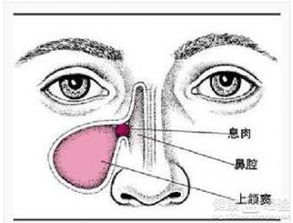 鼻窦炎鼻甲肥大鼻息肉过敏鼻炎如何保养