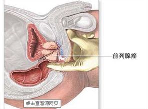 要治疗晚期前列腺癌 新疗法已出现 