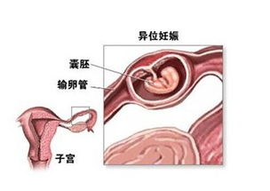 宫外孕怎么手术,宫外孕是一种危险的妊娠