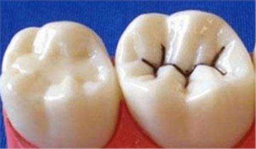 蛀牙龋齿怎么补救 个护师总结13条预防治疗经验