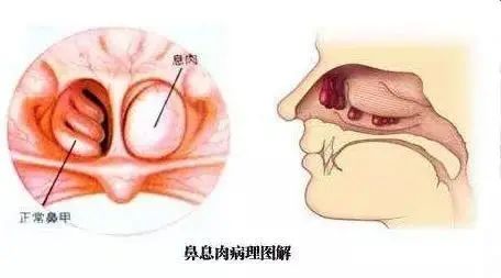 女子鼻塞流鼻涕,以为是感冒,结果被医生告知鼻子里长了 荔枝