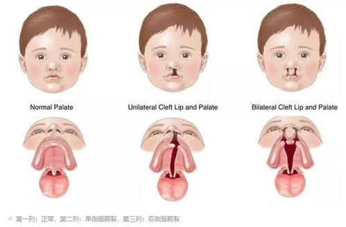 怀孕6个月查出宝宝有兔唇,这种缺陷是先天还是后天,会遗传吗