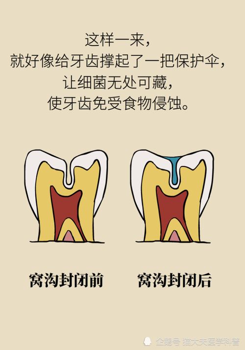 小朋友有必要涂氟和窝沟封闭吗