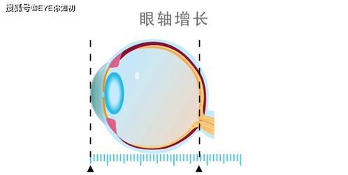 为什么已经成年了,近视度数还在涨 涨 涨