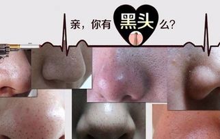 脸上毛孔粗大有黑头怎么解决 教你2个不容易错过的低成本实用妙招